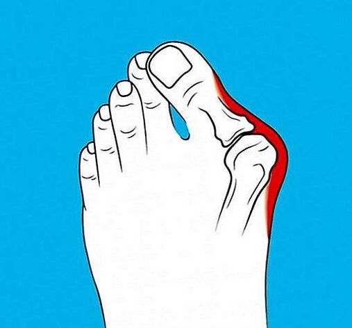 Artrosis de la articulación del dedo del pie