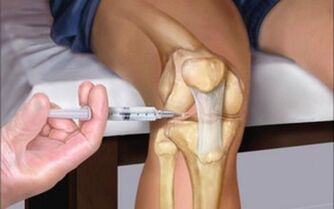 inyección intraarticular en la articulación en la osteoartritis