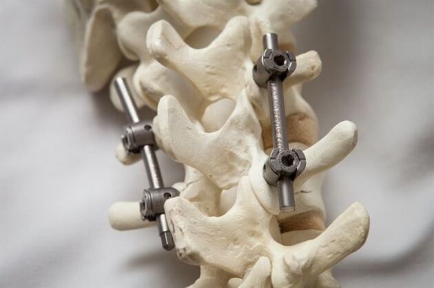 Fijación de la osteocondrosis de la columna vertebral del cuello. 