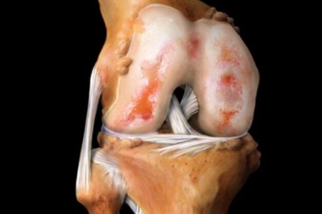 Daño del cartílago en la osteoartritis de rodilla
