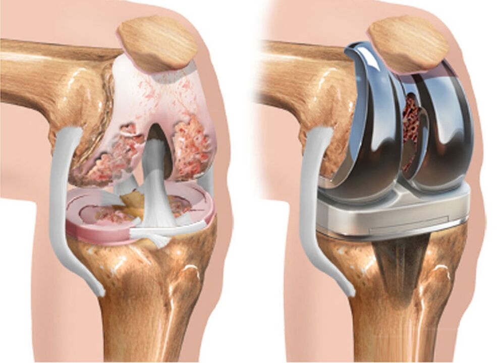 antes y después de la osteoartritis de la articulación de la rodilla en la osteoartritis