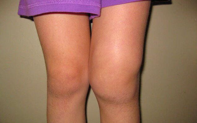 articulación de la rodilla hinchada debido a la osteoartritis