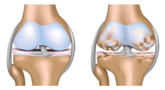 cartílago sano y daño a la articulación de la rodilla en la osteoartritis