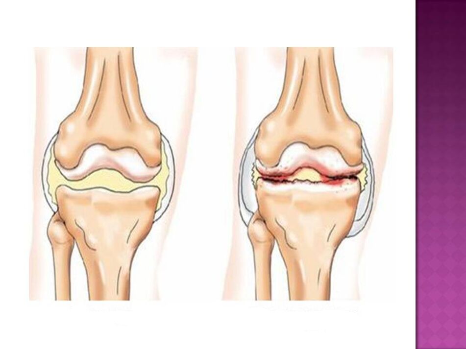 La articulación es normal (izquierda) y afectada por osteoartritis (derecha)