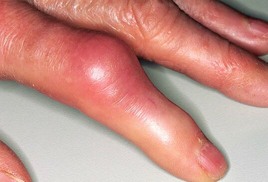 La gota se acompaña de dolor intenso en los dedos e hinchazón de las articulaciones. 