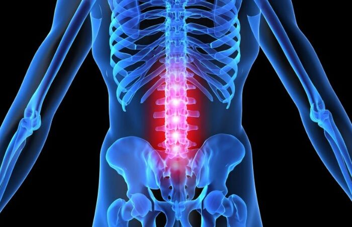 Osteocondrosis de la región lumbar