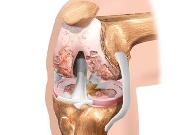 Daño a la carartrosis de la rodilla