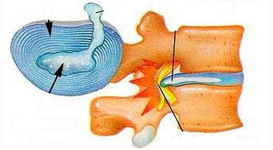 Características del desarrollo de la osteocondrosis del cuello uterino