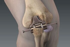 Reemplazo de rodilla por osteoartritis