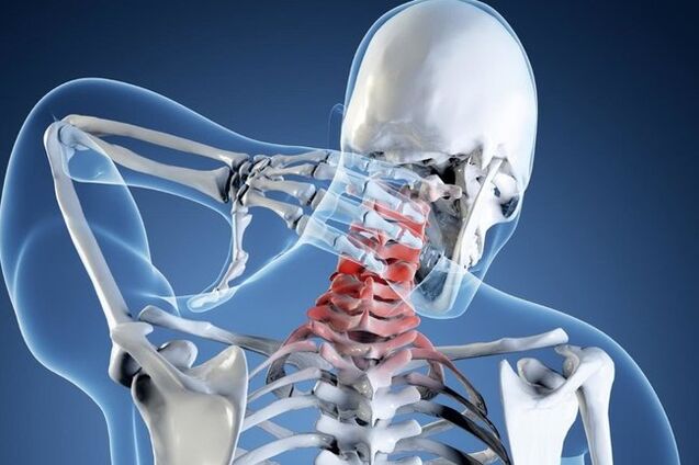 Osteocondrosis de la columna cervical.
